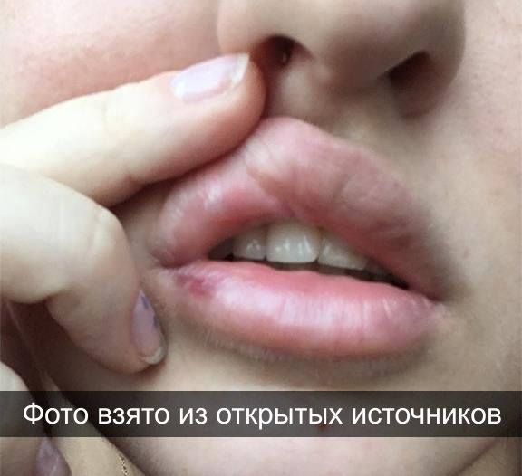 Побочные явления при контурной пластике губ | filler.by