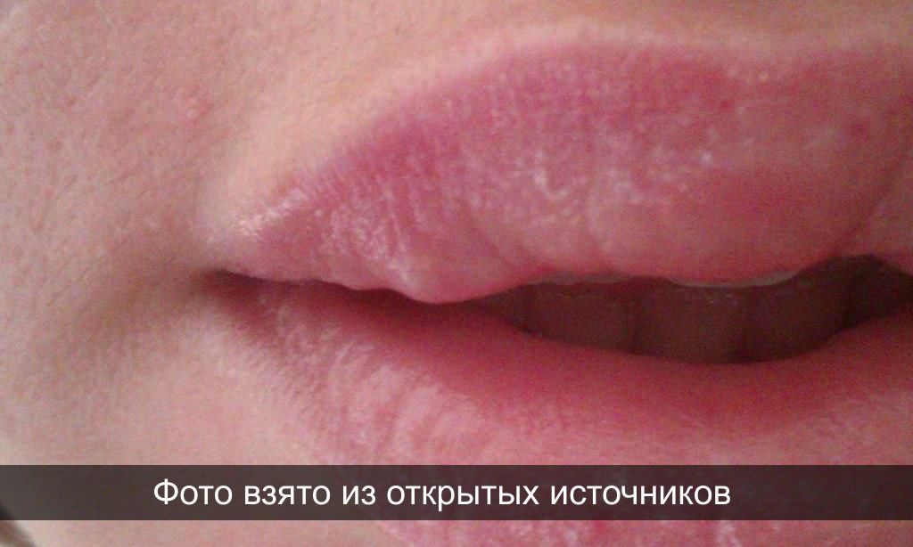 Побочные явления при контурной пластике губ | filler.by